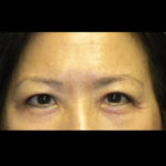 Lower Blepharoplasty Before & After Patient #4304