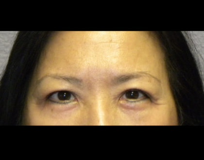Lower Blepharoplasty Before & After Patient #4304