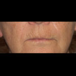 Active & Max FX Laser Before & After Patient #4570