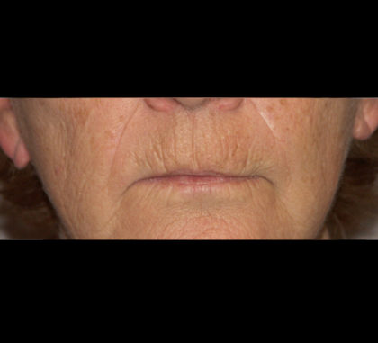 Active & Max FX Laser Before & After Patient #4570