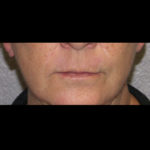 Active & Max FX Laser Before & After Patient #4570
