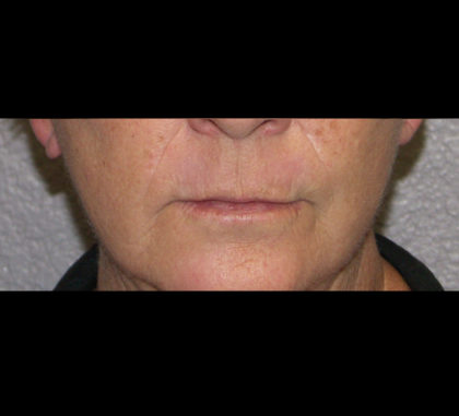 Active & Max FX Laser Before & After Patient #4570