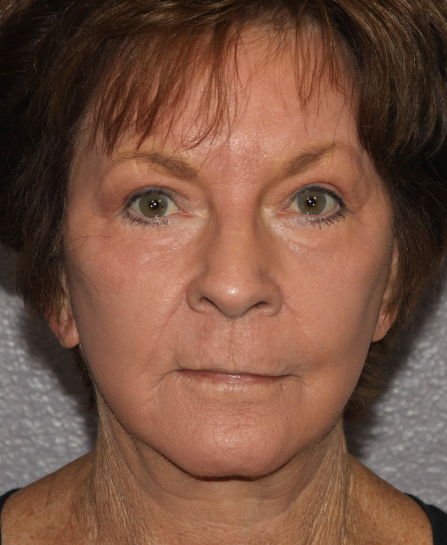 Active & Max FX Laser Before & After Patient #4569