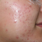 Micro-Needling w/ PRP Before & After Patient #4447