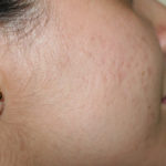 Micro-Needling w/ PRP Before & After Patient #4447