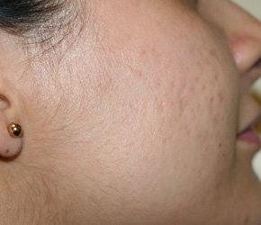 Micro-Needling w/ PRP Before & After Patient #4447