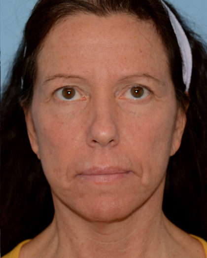Mini Facelift Before & After Patient #4253