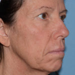 Mini Facelift Before & After Patient #4253