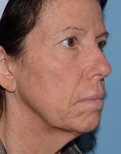 Mini Facelift Before & After Patient #4253