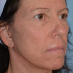 Mini Facelift Before & After Patient #4253