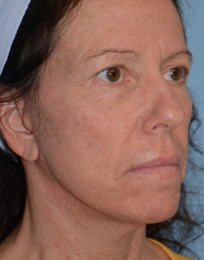 Mini Facelift Before & After Patient #4253