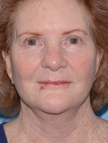 Mini Facelift Before & After Patient #4455