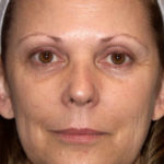 Mini Facelift Before & After Patient #4460