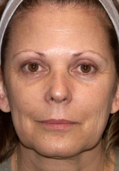 Mini Facelift Before & After Patient #4460