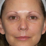 Mini Facelift Before & After Patient #4460