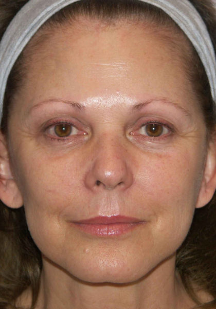 Mini Facelift Before & After Patient #4460