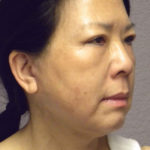 Mini Facelift Before & After Patient #4471