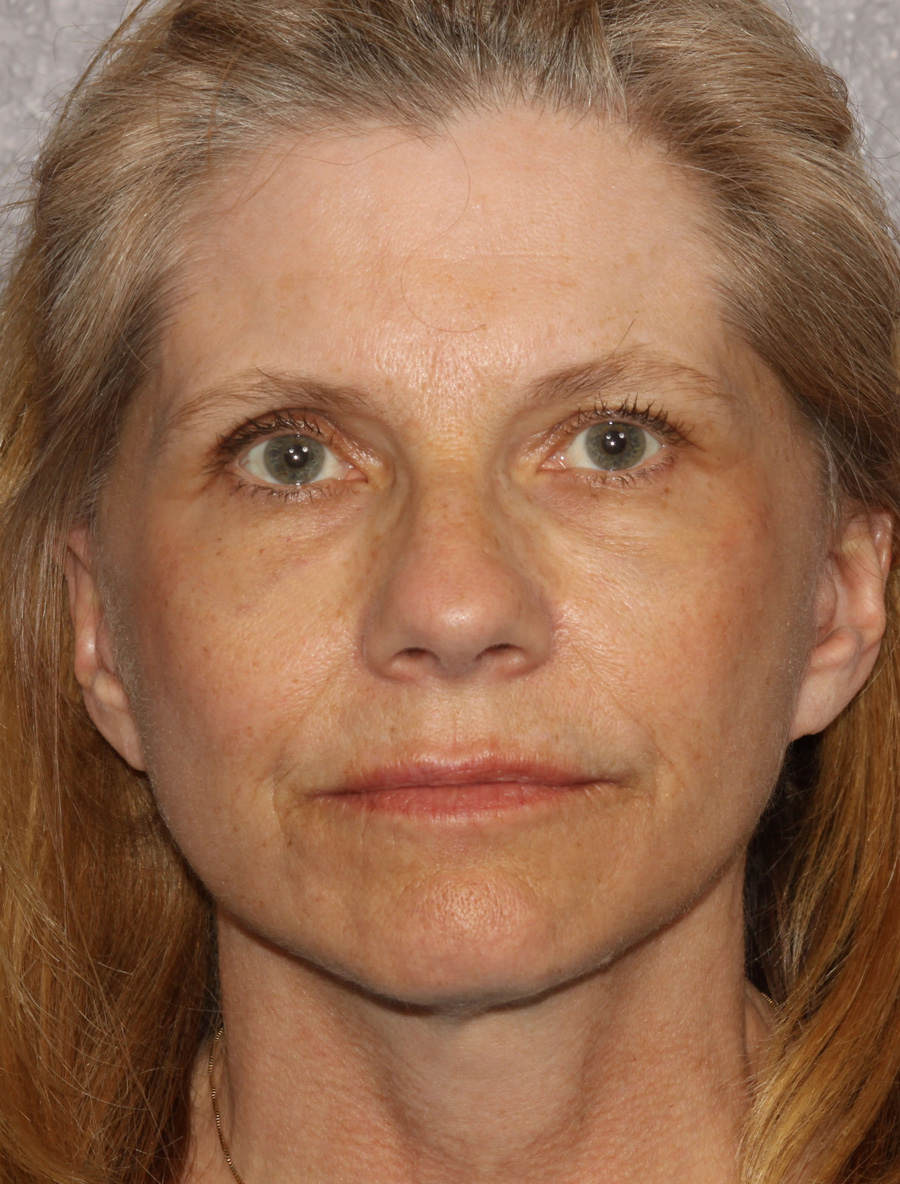 Mini Facelift Before & After Patient #4478
