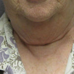 Neck Lift Before & After Patient #4501