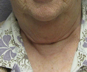 Neck Lift Before & After Patient #4501