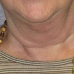 Neck Lift Before & After Patient #4501