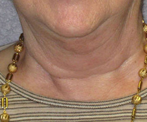 Neck Lift Before & After Patient #4501