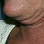 Neck Liposuction Before & After Patient #4505
