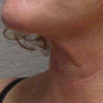 Neck Liposuction Before & After Patient #4505