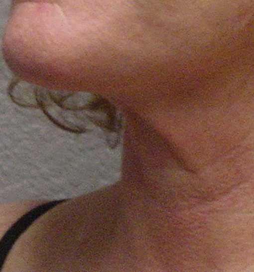 Neck Liposuction Before & After Patient #4505