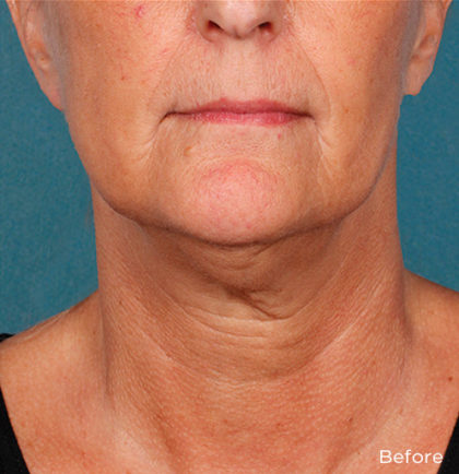 Kybella Before & After Patient #4413