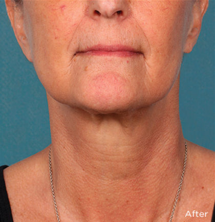 Kybella Before & After Patient #4413