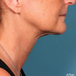 Kybella Before & After Patient #4413