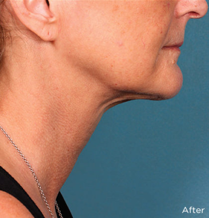 Kybella Before & After Patient #4413