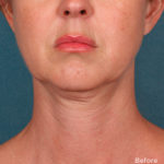 Kybella Before & After Patient #4418