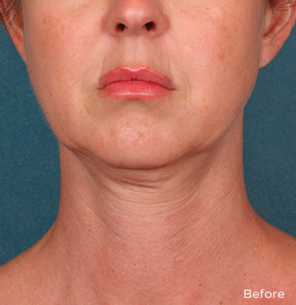 Kybella Before & After Patient #4418