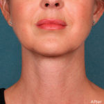 Kybella Before & After Patient #4418