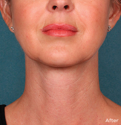 Kybella Before & After Patient #4418