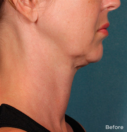 Kybella Before & After Patient #4418