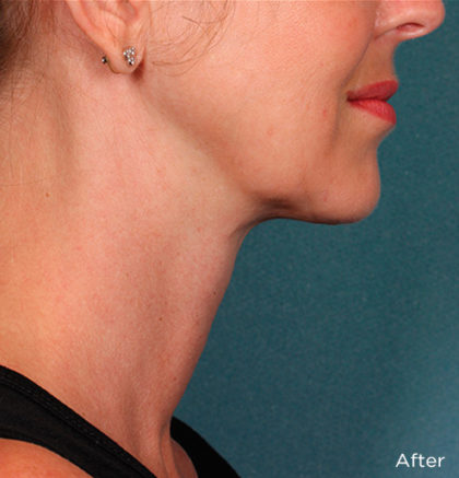 Kybella Before & After Patient #4418