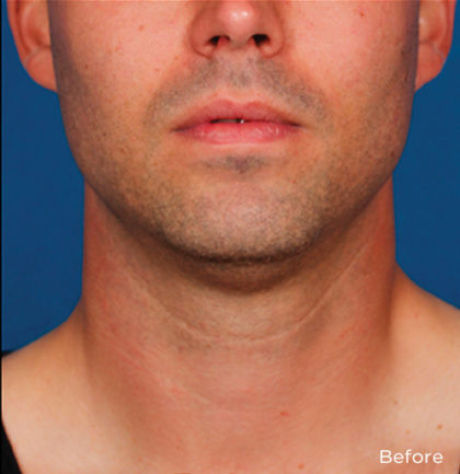 Kybella Before & After Patient #4423