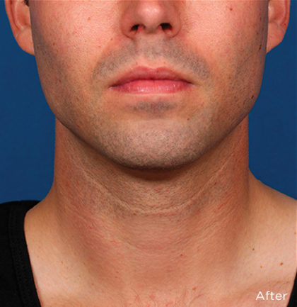 Kybella Before & After Patient #4423