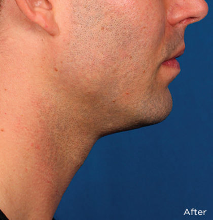 Kybella Before & After Patient #4423