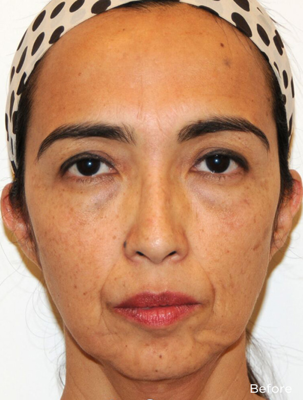 Y Lift Before & After Patient #4628