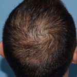 Hair Restoration w/ PRP Before & After Patient #4343