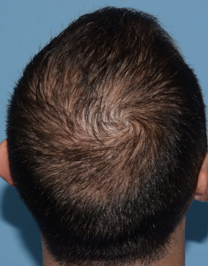 Hair Restoration w/ PRP Before & After Patient #4343