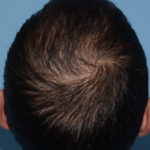 Hair Restoration w/ PRP Before & After Patient #4343