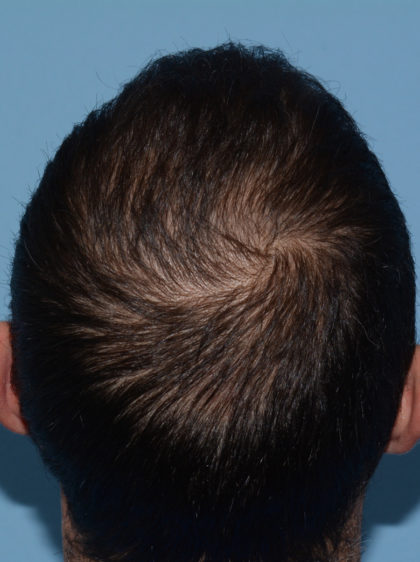 Hair Restoration w/ PRP Before & After Patient #4343