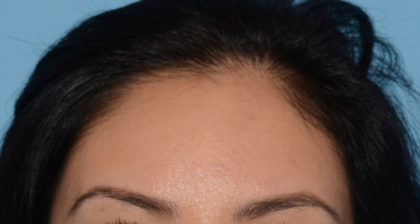 Hair Restoration w/ PRP Before & After Patient #4349