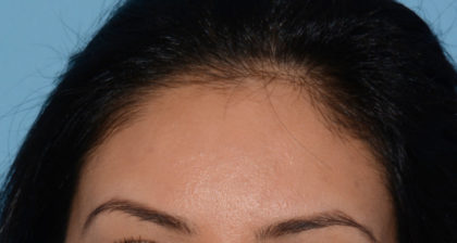 Hair Restoration w/ PRP Before & After Patient #4349