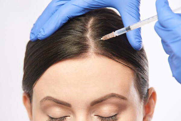 platelet rich plasma for hair loss procedure